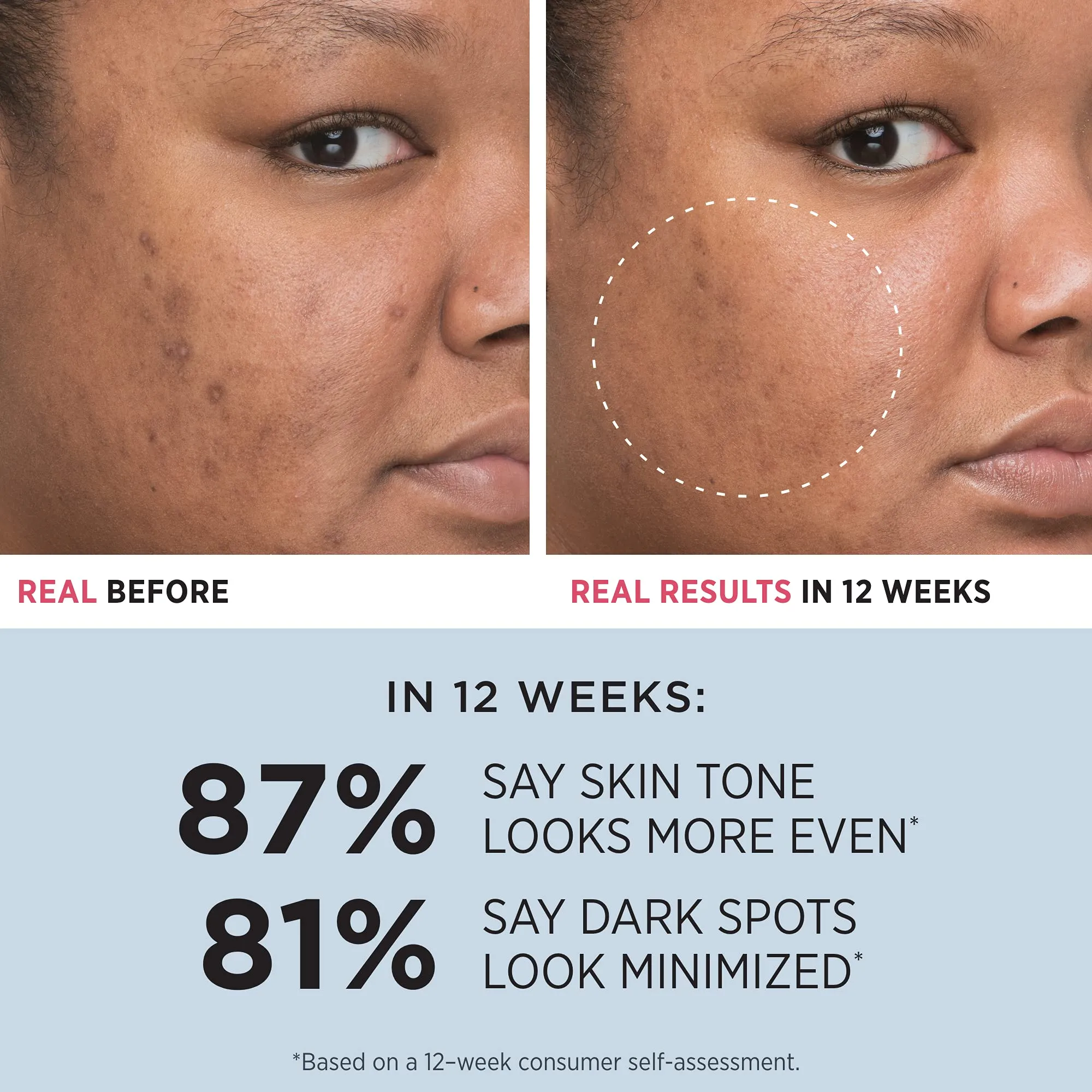 IT Cosmetics Bye Bye Dark Spots 4% Niacinamide Serum - Visibly Reduces Dark Spots & Improves Skin Clarity In 8 Weeks - With 1% Ethyl Vitamin C - For All Skin Types - 1 fl oz